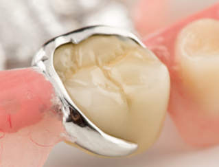 Бюгельный протез для восстановления зубов