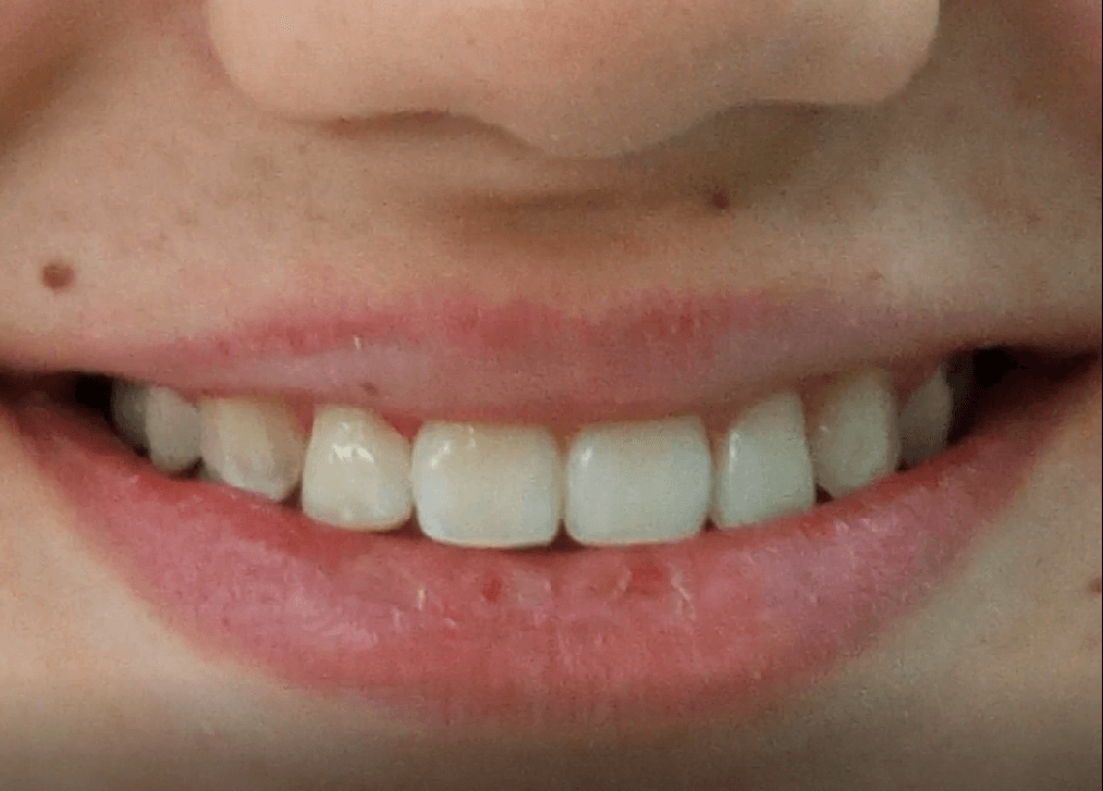 импланты зубов сколько времени занимает как узнать свои списания на мтс