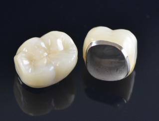 В каких случаях используются коронки из металлокерамики: жевательные или передние зубы